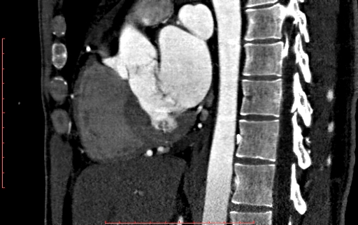 File:Anomalous left coronary artery from the pulmonary artery (ALCAPA) (Radiopaedia 70148-80181 C 121).jpg