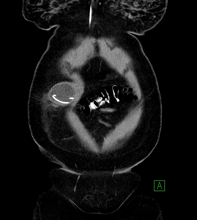 Anterior abdominal wall CSF pseudocyst (CSFoma) (Radiopaedia 79453-92571 B 13).jpg