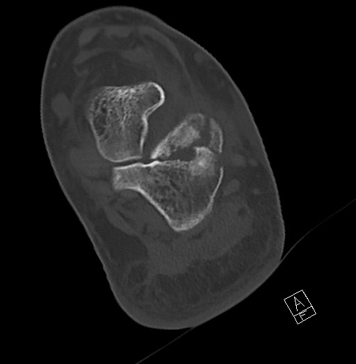 Anterior calcaneal process fracture (Radiopaedia 63353-71943 Axial bone window 96).jpg