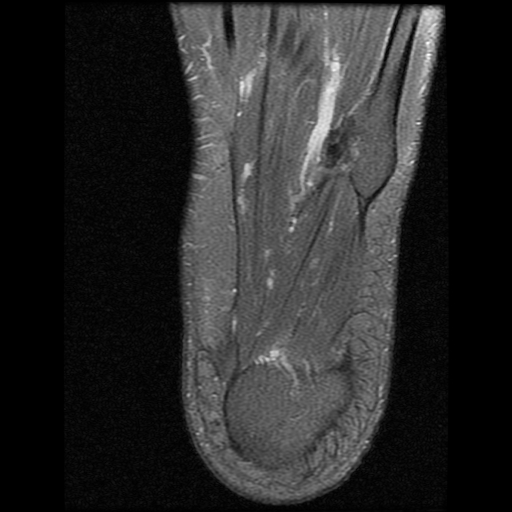 File:Anterior calcaneal process fracture (Radiopaedia 74654-85611 Axial PD fat sat 27).jpg