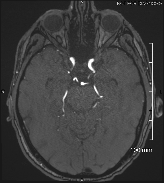Anterior cerebral artery aneurysm (Radiopaedia 80683-94127 Axial MRA 89).jpg