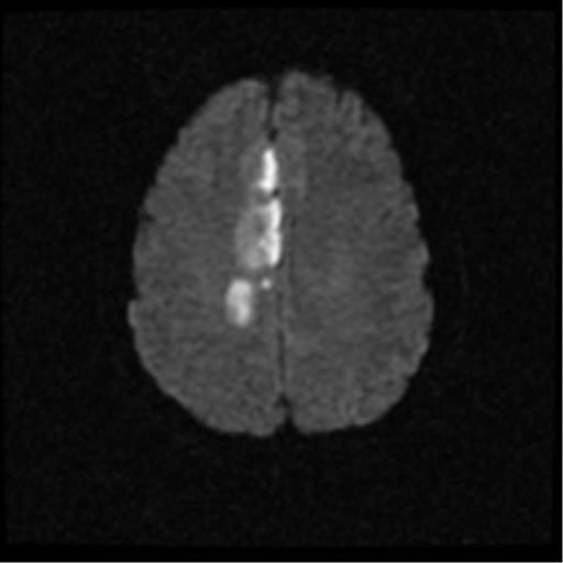 File:Anterior cerebral artery territory infarct (Radiopaedia 39327-41584 Axial DWI 18).png