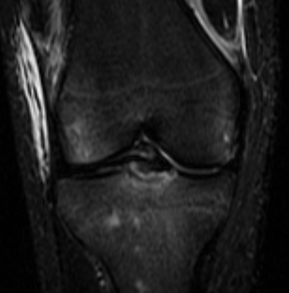 File:Anterior cruciate ligament bony avulsion (MRI) (Radiopaedia 14273-14151 Coronal STIR 1).jpg