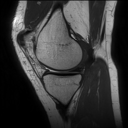 Anterior cruciate ligament rupture and posteromedial corner injury (Radiopaedia 67338-76723 Sagittal PD 56).jpg