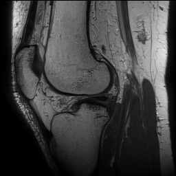 Anterior cruciate ligament rupture with Segond fracture (Radiopaedia 69043-78806 Sagittal PD 111).jpg