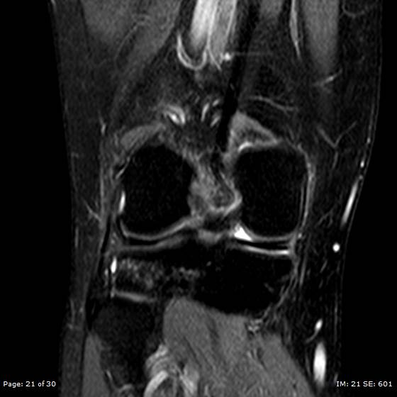 File:Anterior cruciate ligament tear (Radiopaedia 70783-80964 Coronal STIR 21).jpg