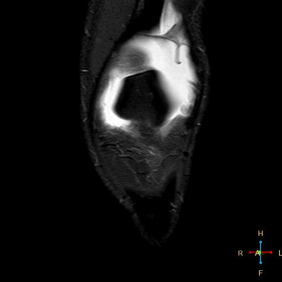 File:Anterior cruciate ligament tear - complete (Radiopaedia 24907-25170 Coronal STIR 3).jpg