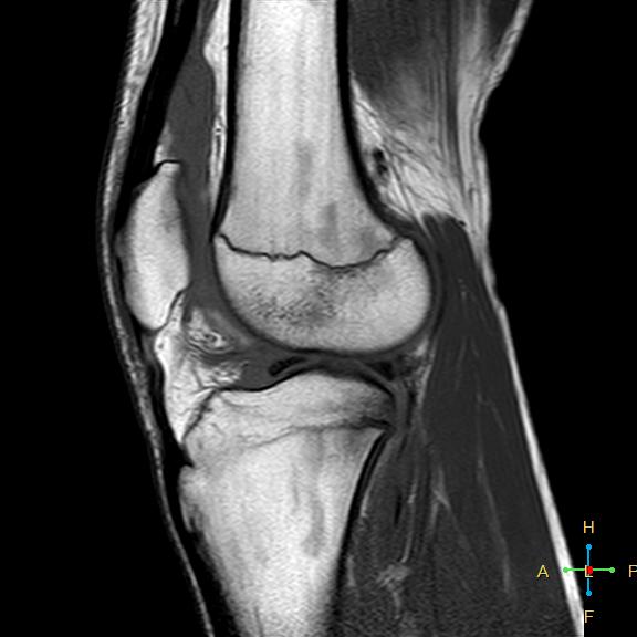 File:Anterior cruciate ligament tear - complete (Radiopaedia 24907-25170 Sagittal T1 6).jpg