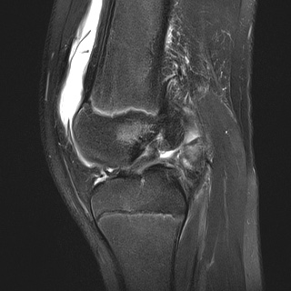 File:Anterior cruciate ligament tear - pediatric (Radiopaedia 62152-70260 Sagittal PD fat sat 19).jpg
