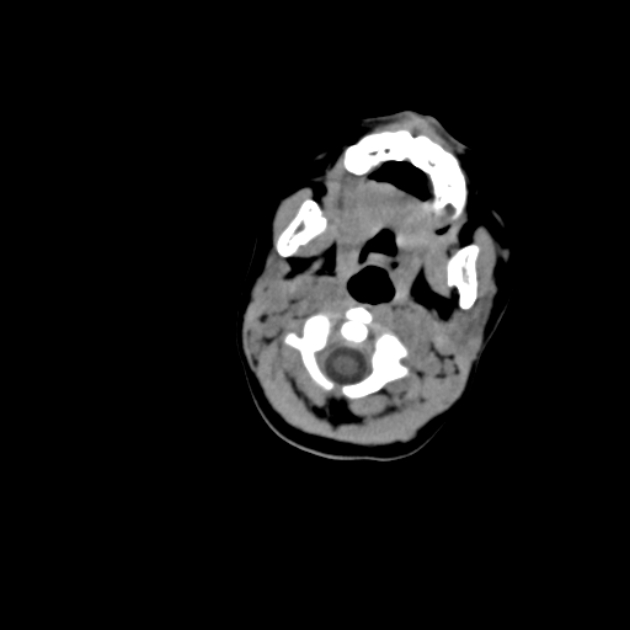 Anterior fontanelle inclusion cyst (Radiopaedia 62003-70087 Axial non-contrast 12).jpg