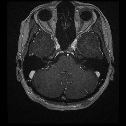 Anterior inferior cerebellar artery vascular loop - type II (Radiopaedia 70991-81209 Axial T1 C+ 47).jpg