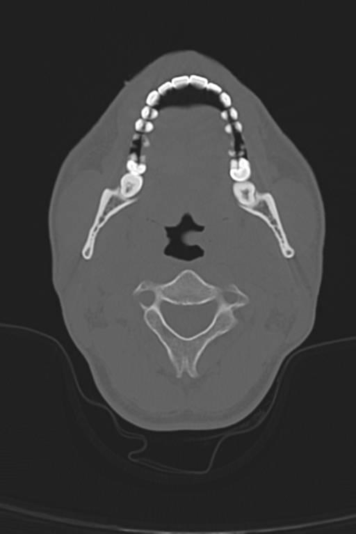 Anterior nasal spine fracture (Radiopaedia 46138-50494 Axial bone window 64).png
