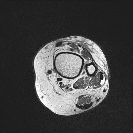 File:Anterior talofibular ligament injury - rupture with soft-tissue impingement (Radiopaedia 38765-40928 Axial PD 4).jpg