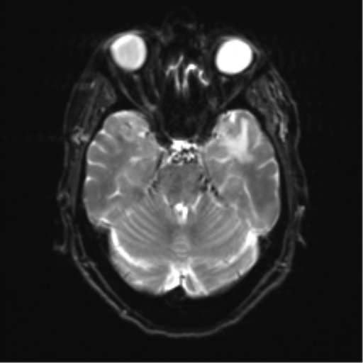 Anterior temporal pole cysts (Radiopaedia 46629-51102 Axial DWI 9).png