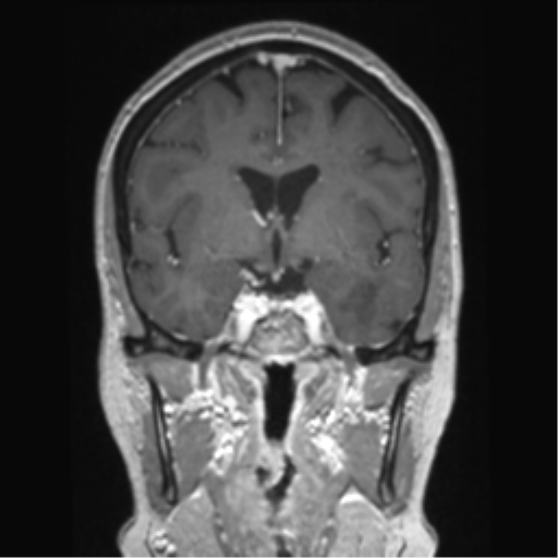 Anterior temporal pole cysts (Radiopaedia 46629-51102 Coronal T1 C+ 100).png