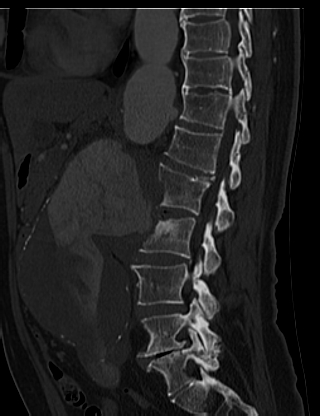 File:Anterior vertebral scalloping (abdominal aortic aneurysm) (Radiopaedia 66744-76067 Sagittal bone window 25).jpg