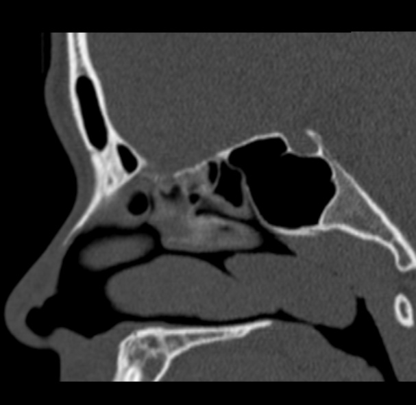 Antrochoanal polyp (Radiopaedia 33984-35202 Sagittal bone window 37).jpg
