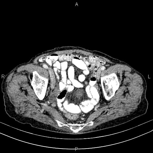 File:Aortic aneurysm and Lemmel syndrome (Radiopaedia 86499-102554 A 69).jpg