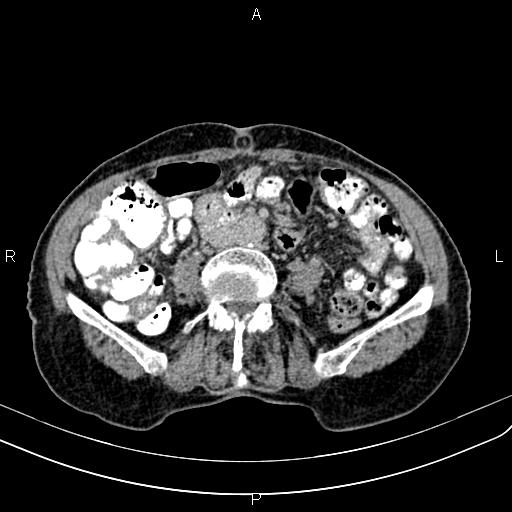 Aortic aneurysm and Lemmel syndrome (Radiopaedia 86499-102554 Axial C+ delayed 46).jpg