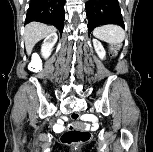 Aortic aneurysm and Lemmel syndrome (Radiopaedia 86499-102554 C 50).jpg