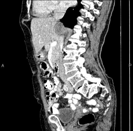 Aortic aneurysm and Lemmel syndrome (Radiopaedia 86499-102554 D 40).jpg