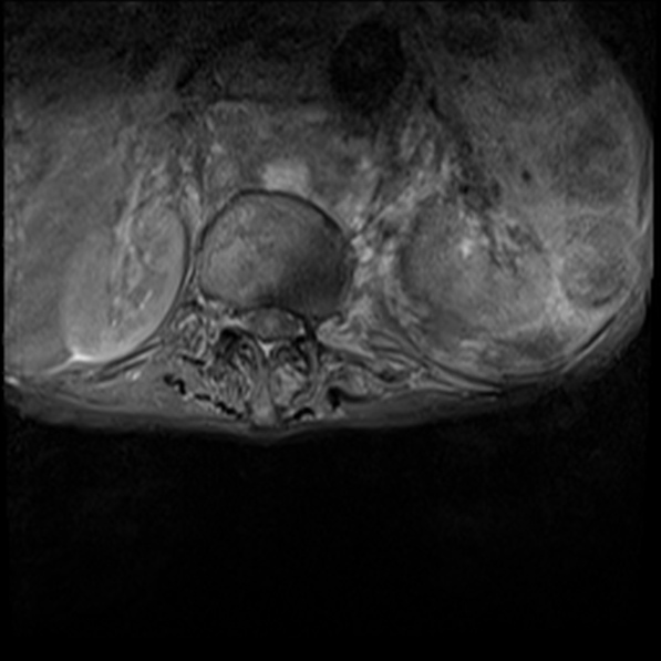 File:Aortic aneurysm with spinal destruction (Radiopaedia 42301-45409 Axial T1 fat sat 3).jpg