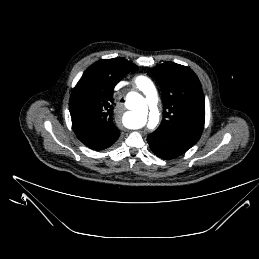 Aortic arch aneurysm (Radiopaedia 84109-99365 B 216).jpg