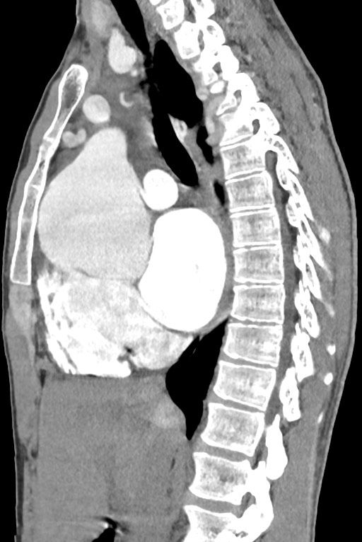 Aortic coarctation with aneurysm (Radiopaedia 74818-85828 B 77).jpg