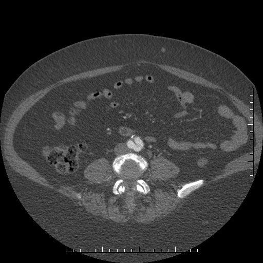 File:Aortic dissection- Stanford A (Radiopaedia 35729-37268 C 36).jpg