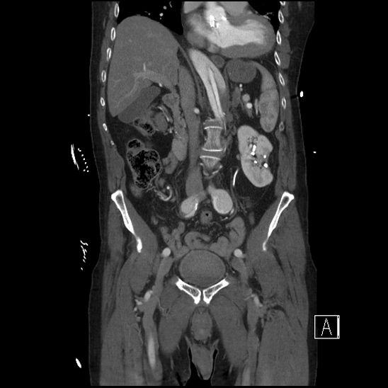 File:Aortic dissection (CTPA) (Radiopaedia 75506-86750 F 32).jpg