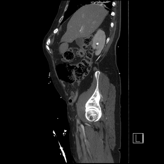 Aortic dissection (CTPA) (Radiopaedia 75506-86750 G 25).jpg