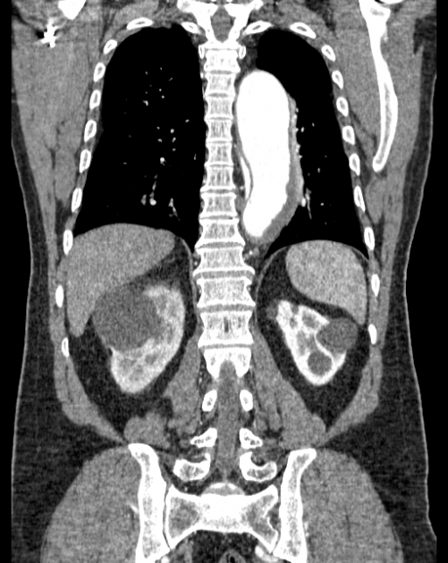 Aortic dissection (Radiopaedia 44411-48061 A 48).jpg