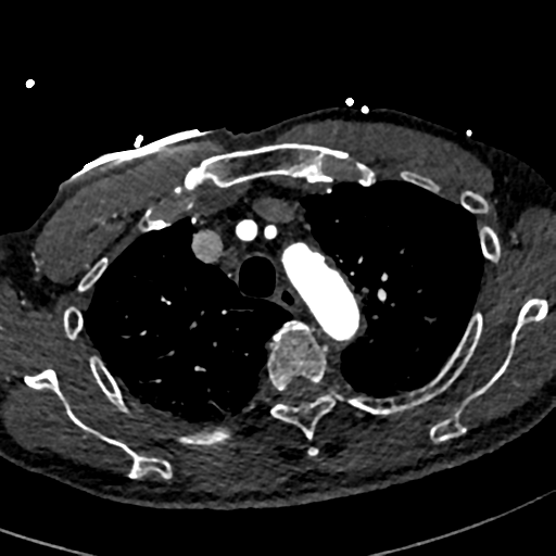 File:Aortic dissection - DeBakey type II (Radiopaedia 64302-73082 A 22).png