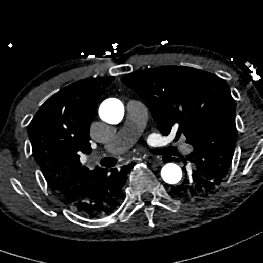 File:Aortic dissection - DeBakey type II (Radiopaedia 64302-73082 A 40).png