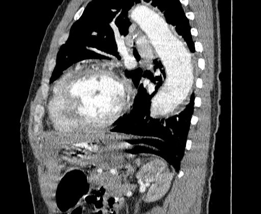 Aortic dissection - Stanford A -DeBakey I (Radiopaedia 28339-28587 C 64).jpg