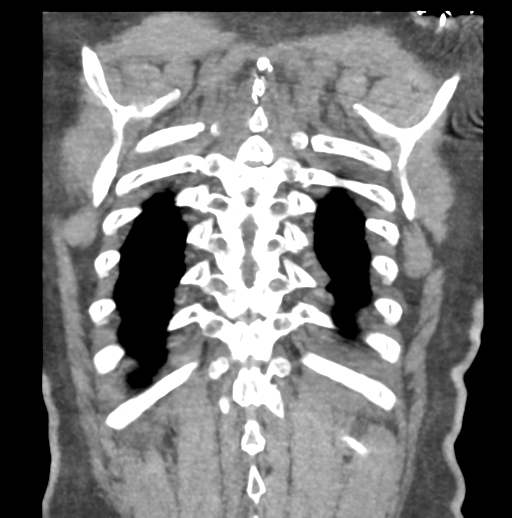 File:Aortic dissection - Stanford type B (Radiopaedia 50171-55512 B 75).png
