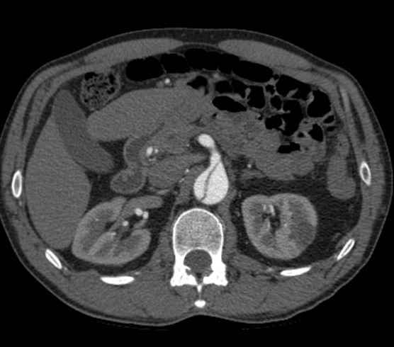 Aortic dissection - Stanford type B (Radiopaedia 73648-84437 A 137).jpg