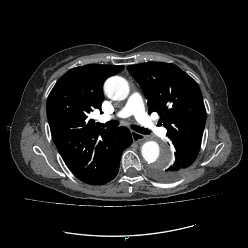 File:Aortic dissection extended to lusory artery (Radiopaedia 43686-47136 B 6).jpg