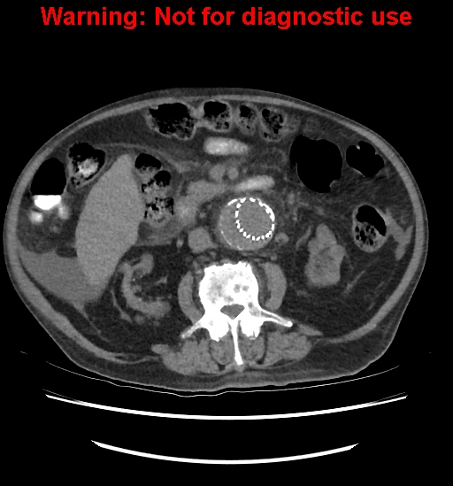Aortic graft infection (Radiopaedia 44979-48907 Axial non-contrast 48).jpg