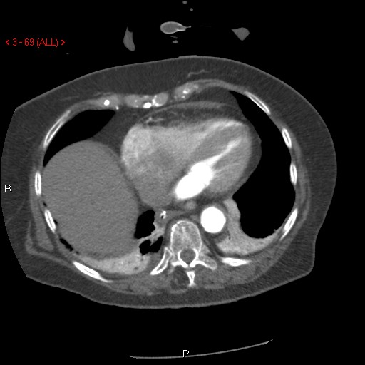 Aortic intramural hematoma (Radiopaedia 27746-28001 A 69).jpg
