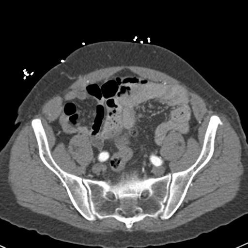 File:Aortic intramural hematoma (Radiopaedia 31139-31838 B 141).jpg