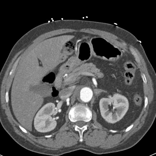 Aortic intramural hematoma (Radiopaedia 31139-31838 B 92).jpg