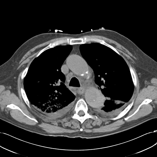Aortic intramural hematoma (Radiopaedia 34260-35540 Axial non-contrast 22).png
