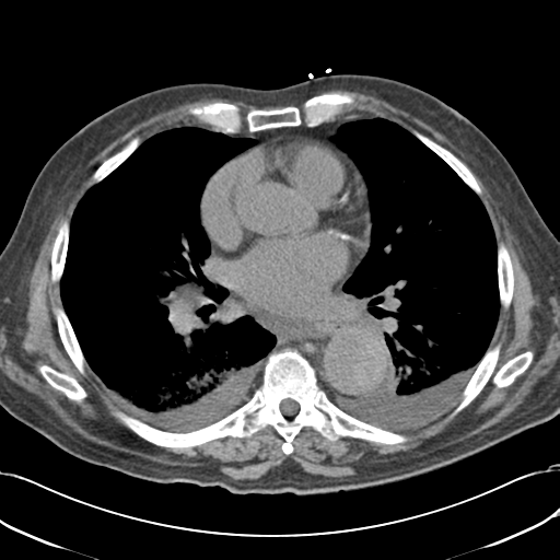 Aortic intramural hematoma (Radiopaedia 34260-35540 Axial non-contrast 35).png
