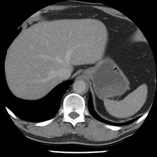 File:Aortic intramural hematoma (type B) (Radiopaedia 79323-92387 Axial C+ delayed 49).jpg