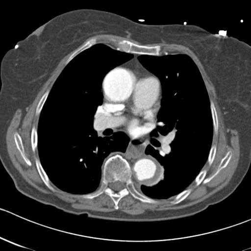 Aortic intramural hematoma from penetrating atherosclerotic ulcer (Radiopaedia 31137-31836 A 40).jpg