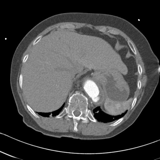 Aortic intramural hematoma from penetrating atherosclerotic ulcer (Radiopaedia 31137-31836 A 69).jpg