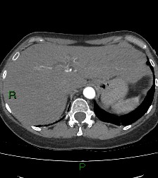 Aortic valve endocarditis (Radiopaedia 87209-103485 C 89).jpg