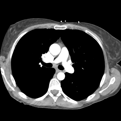 Aortic valve non-coronary cusp thrombus (Radiopaedia 55661-62189 B 21).png