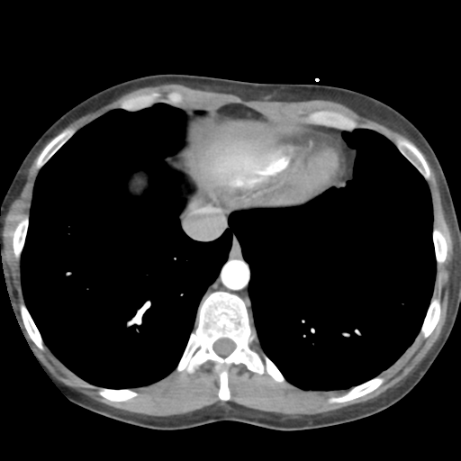 File:Aortic valve non-coronary cusp thrombus (Radiopaedia 55661-62189 B 40).png